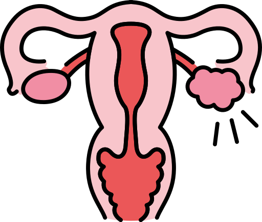 A simplified illustration of the female reproductive system, with labeled ovaries, fallopian tubes, uterus, and a cyst on the ovary.