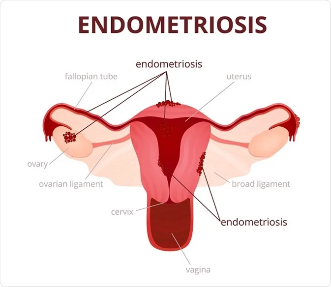 An illustration of the female reproductive system showing endometriosis affecting the uterus, ovaries, fallopian tubes, and surrounding areas.