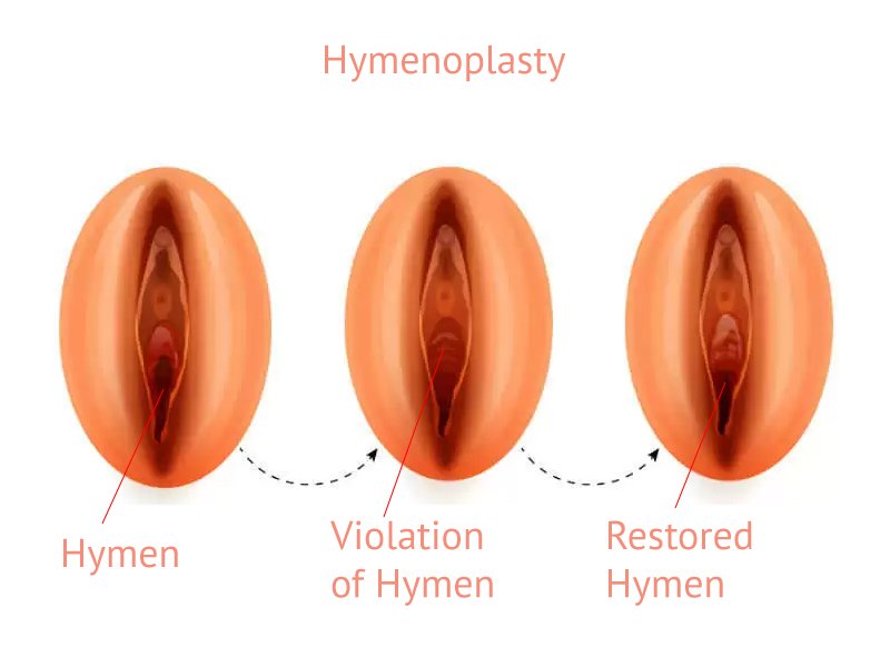 Illustration showing the stages of hymenoplasty, including the natural hymen, a violated hymen, and a restored hymen.