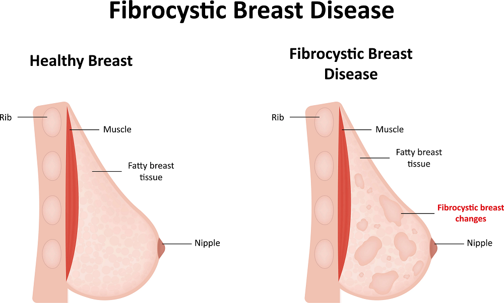 A diagram comparing a healthy breast to one affected by fibrocystic breast disease, highlighting the differences in breast tissue.