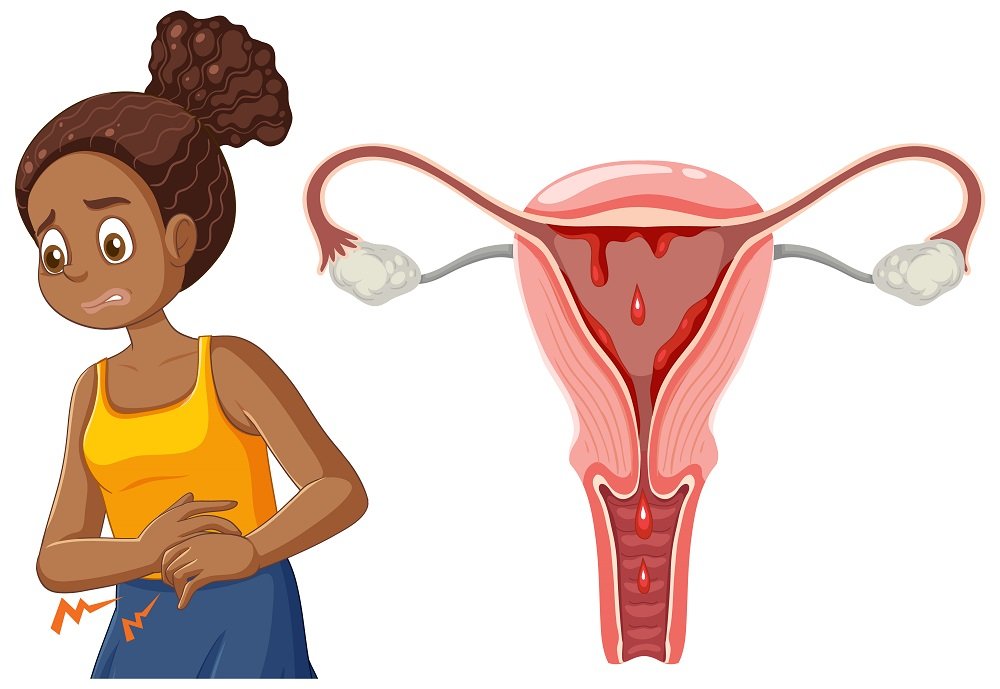 An illustration showing a woman experiencing abdominal pain on the left and a diagram of the uterus with cysts on the right, symbolizing ovarian cysts and menstrual pain.